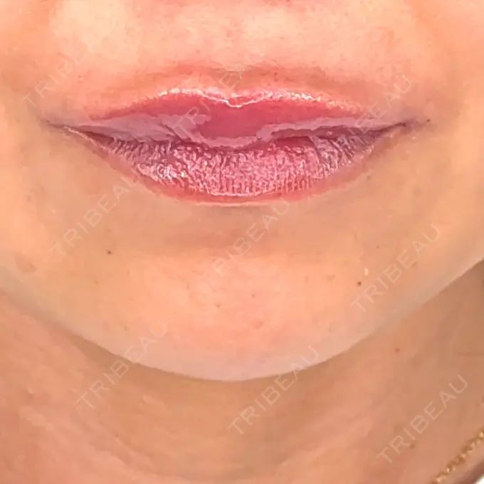 ヒアルロン酸注入（涙袋） / ヒアルロン酸注入（唇） アリエル美容クリニック 横浜院 DAY 0 メイン用