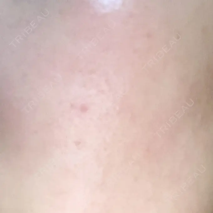 ピーリング（ニキビ・毛穴） 大美会クリニック 岡山院 DAY 2 メイン用