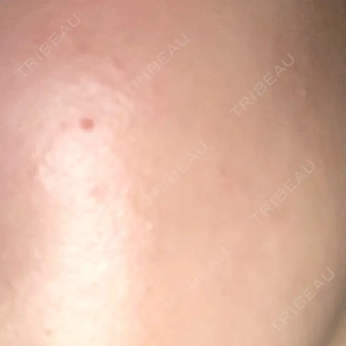 ピーリング（ニキビ・毛穴） 大美会クリニック 岡山院 DAY 3 メイン用