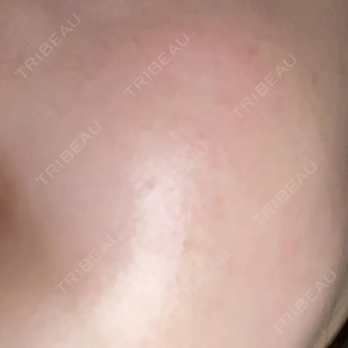 ピーリング（ニキビ・毛穴） 大美会クリニック 岡山院 DAY 4 メイン用