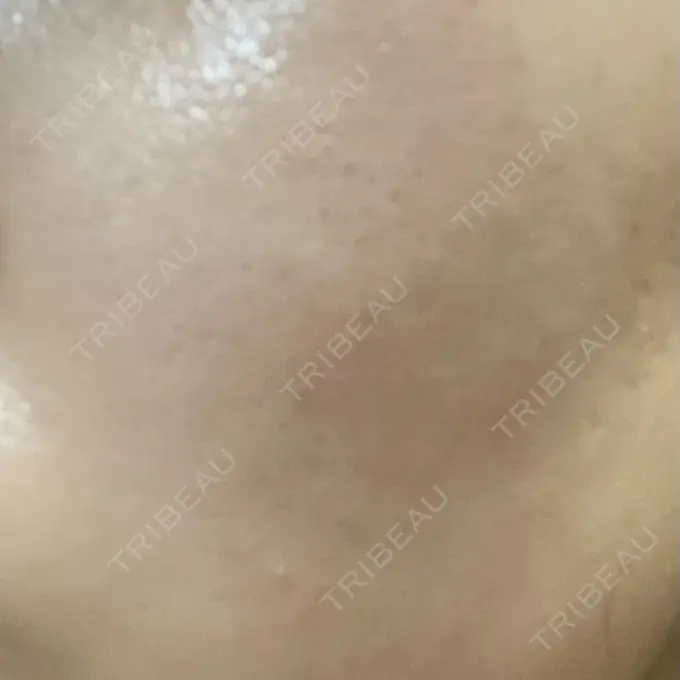 ピーリング（ニキビ・毛穴） 大美会クリニック 岡山院 DAY 6 メイン用