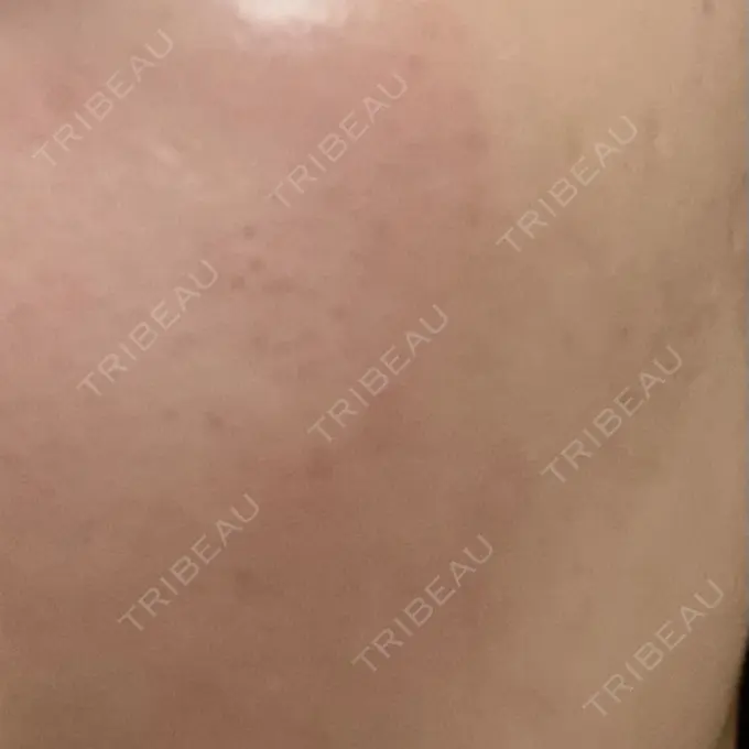 ピーリング（ニキビ・毛穴） 大美会クリニック 岡山院 DAY 7 メイン用