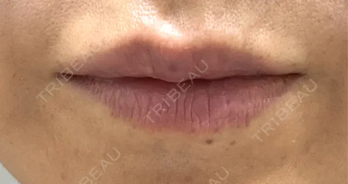 肌ヒアルロン酸注入（たるみ・シワ改善） Grias clinic （ジリアスクリニック） AFTER メイン用