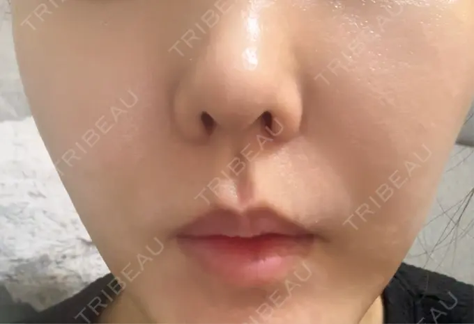 ピーリング（ハリ・ツヤ） / ルメッカ 大美会クリニック 神戸院 DAY 0 メイン用