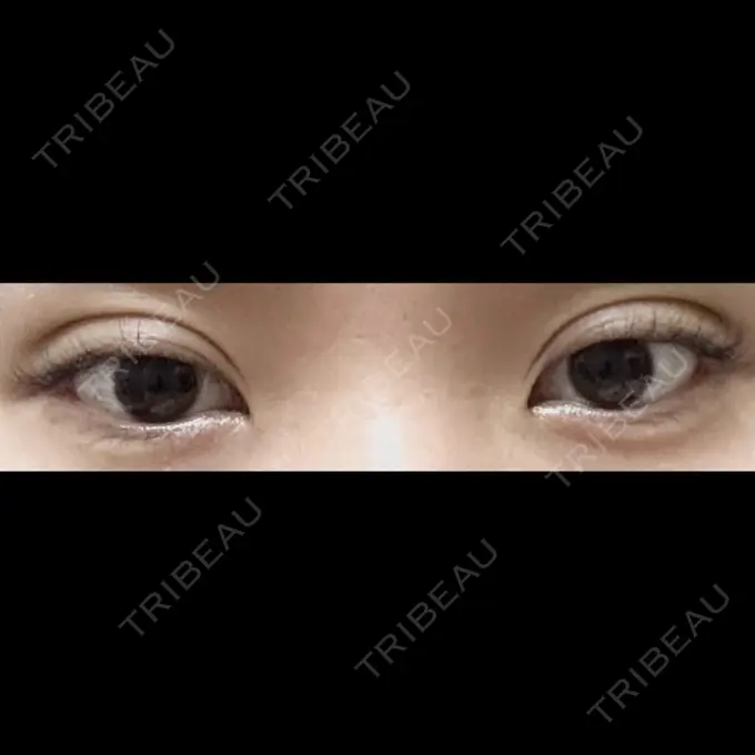 二重埋没 ドクター松井クリニック 新宿 DAY 3 メイン用