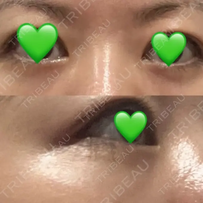 下まぶたの脂肪取り / 脂肪注入（目の下） WOM CLINIC GINZA （ワム クリニック ギンザ） AFTER メイン用