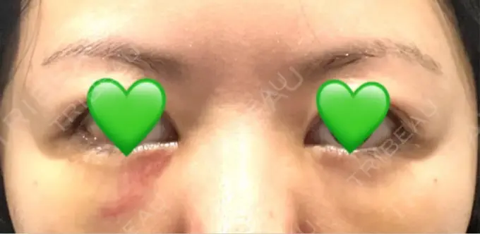 下まぶたの脂肪取り / 脂肪注入（目の下） WOM CLINIC GINZA （ワム クリニック ギンザ） DAY 3 メイン用