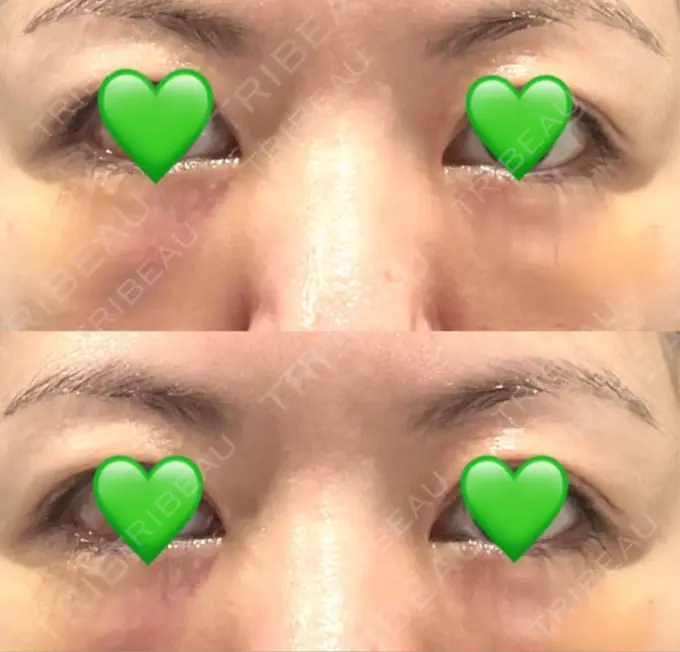 下まぶたの脂肪取り / 脂肪注入（目の下） WOM CLINIC GINZA （ワム クリニック ギンザ） DAY 2 メイン用