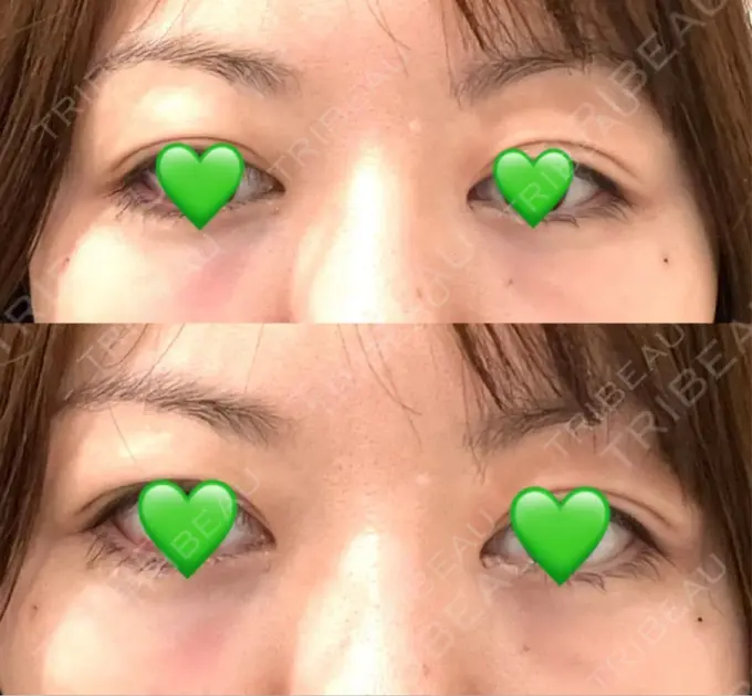 下まぶたの脂肪取り / 脂肪注入（目の下） WOM CLINIC GINZA （ワム クリニック ギンザ） DAY 0 メイン用