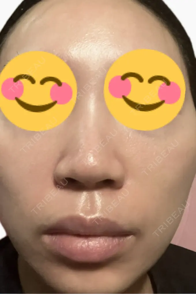 プラセンタ注射 / その他（肌） 美容皮膚科エルムクリニック 麻布院 DAY 7 メイン用