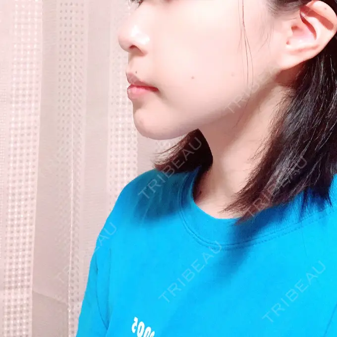 セットバック 大塚美容形成外科・歯科 大塚本院 DAY 114 メイン用