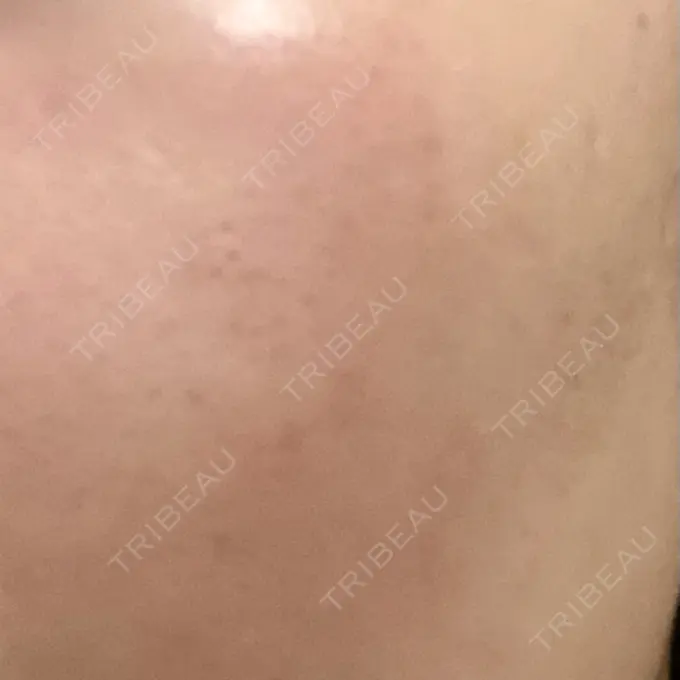 ピーリング（ニキビ・毛穴） 大美会クリニック 岡山院 DAY 8 メイン用