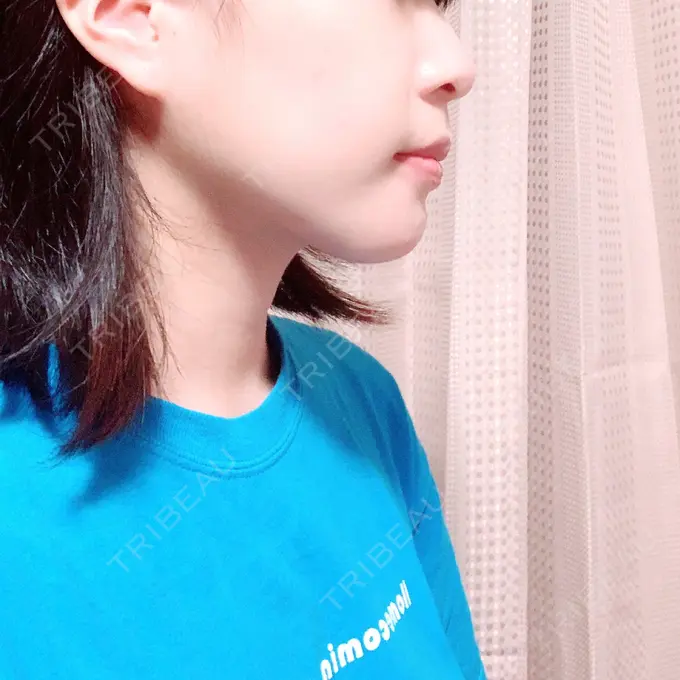 セットバック 大塚美容形成外科・歯科 大塚本院 DAY 114 メイン用