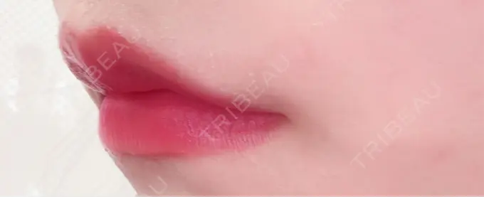 ヒアルロン酸注入（涙袋） / ヒアルロン酸注入（唇） / ボトックス（口角） 日本ウェルネス再生クリニック AFTER メイン用