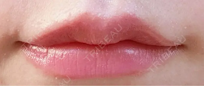 ヒアルロン酸注入（涙袋） / ヒアルロン酸注入（唇） / ボトックス（口角） 日本ウェルネス再生クリニック DAY 2 メイン用