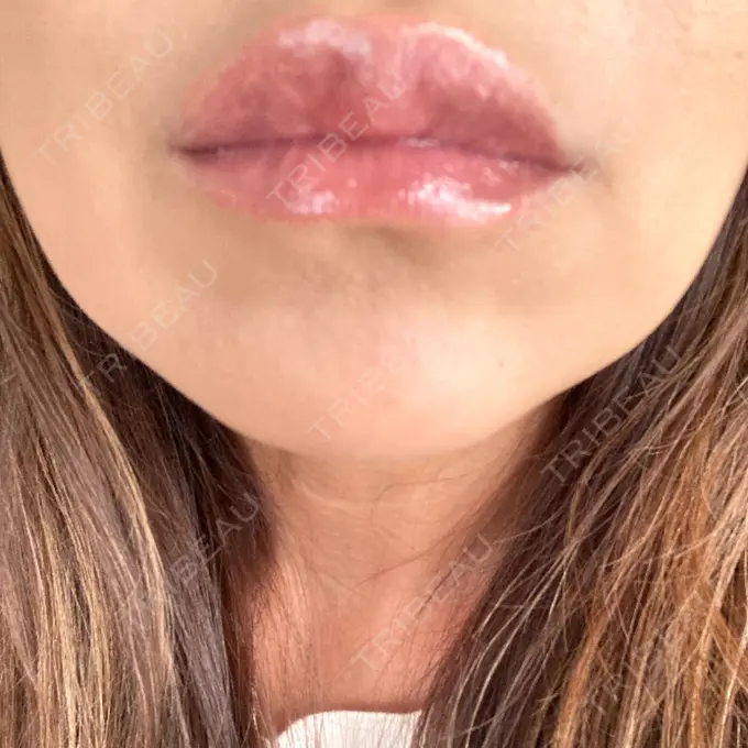 ヒアルロン酸注入（涙袋） / ヒアルロン酸注入（唇） アリエル美容クリニック 横浜院 DAY 4 メイン用