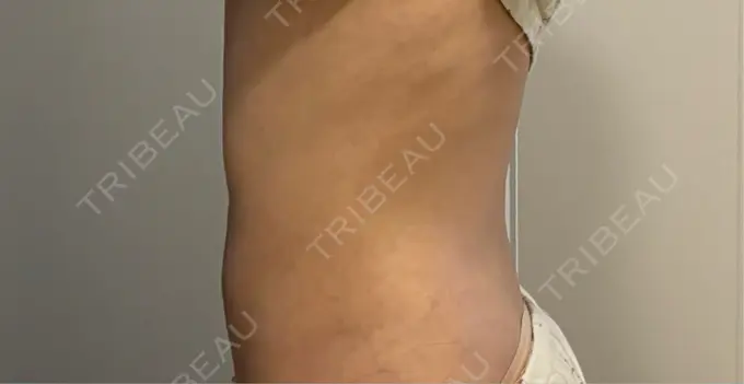 脂肪吸引（お腹） / 脂肪吸引（腰） Mods Clinic（モッズクリニック） 大阪院 DAY 184 メイン用