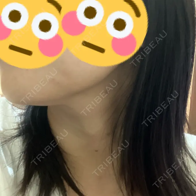 ボトックス（エラ・小顔） eクリニック 大阪院 DAY 0 メイン用