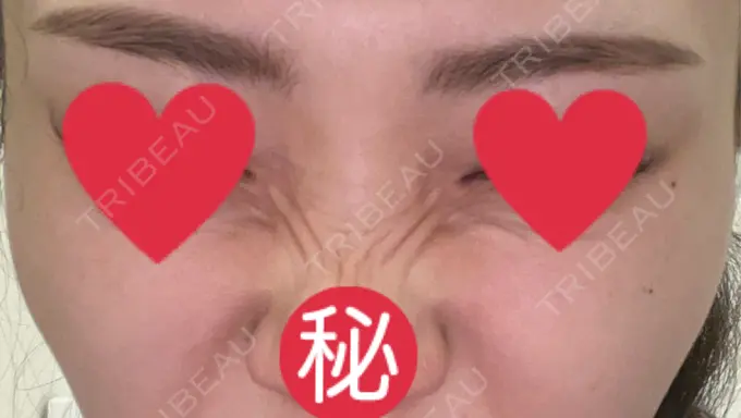 ボトックス（バニーライン） 共立美容外科 広島院 AFTER メイン用