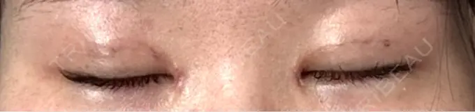 二重埋没 / 目頭切開 eクリニック 福岡院 DAY 7 メイン用