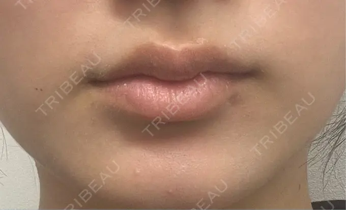 ヒアルロン酸注入（唇） アリエル美容クリニック 横浜院 DAY 6 メイン用