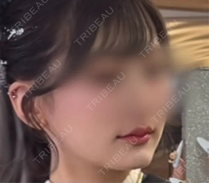 ヒアルロン酸注入（唇） アリエル美容クリニック 横浜院 DAY 7 メイン用