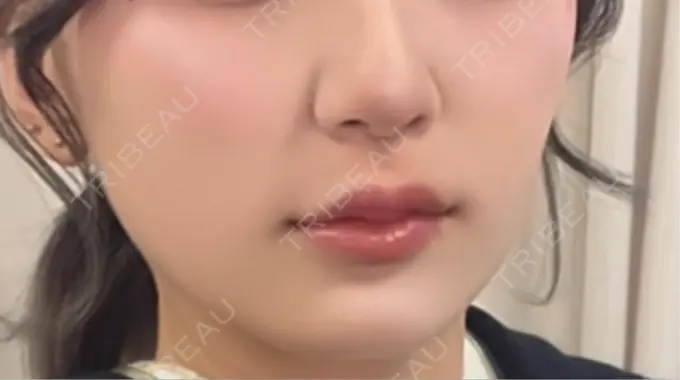 ヒアルロン酸注入（唇） アリエル美容クリニック 横浜院 DAY 7 メイン用