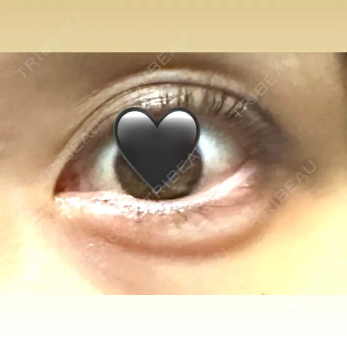 ヒアルロン酸注入（涙袋） アリエル美容クリニック 横浜院 AFTER メイン用