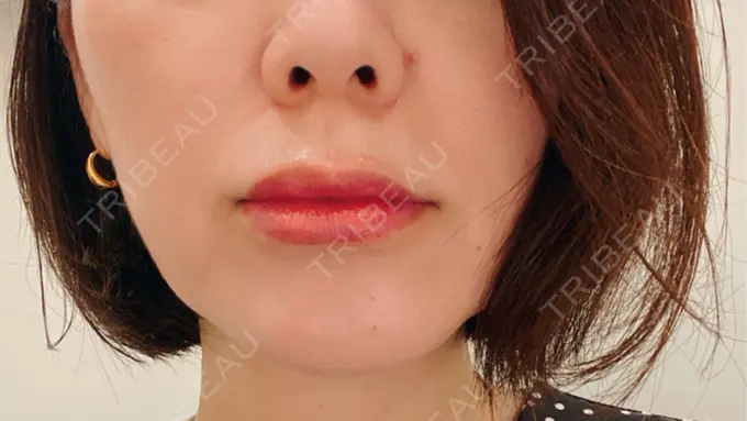 ヒアルロン酸注入（唇） / ヒアルロン酸注入（目の下） アリエル美容クリニック 横浜院 AFTER メイン用
