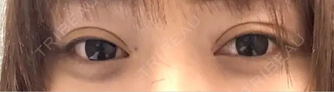 二重埋没 Stand by Beauty Clinic DAY 33 メイン用