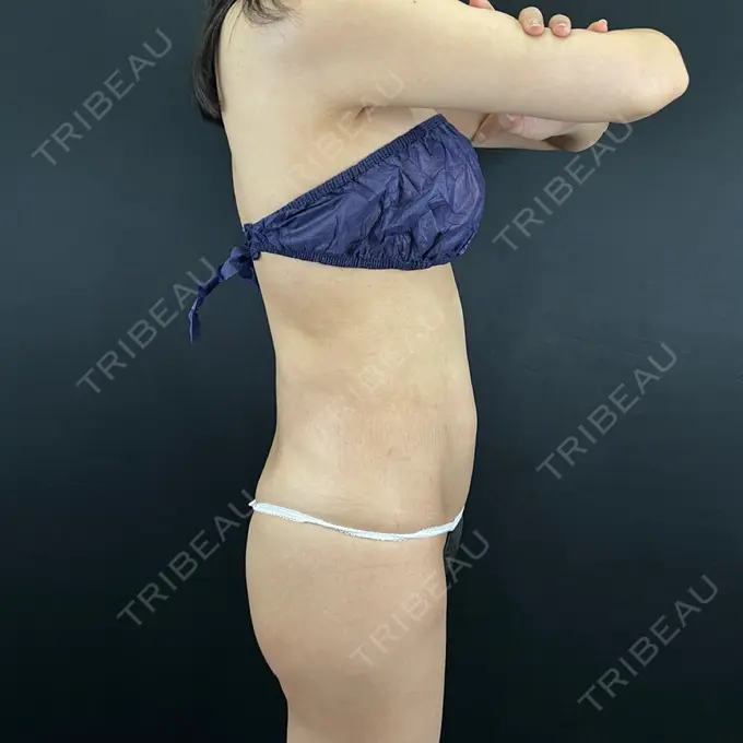 脂肪吸引（脚） / 脂肪吸引（お腹） / 豊胸（脂肪注入） / 脂肪吸引（腰） 藤・ナチュレ美容クリニック 銀座院 DAY 32 メイン用