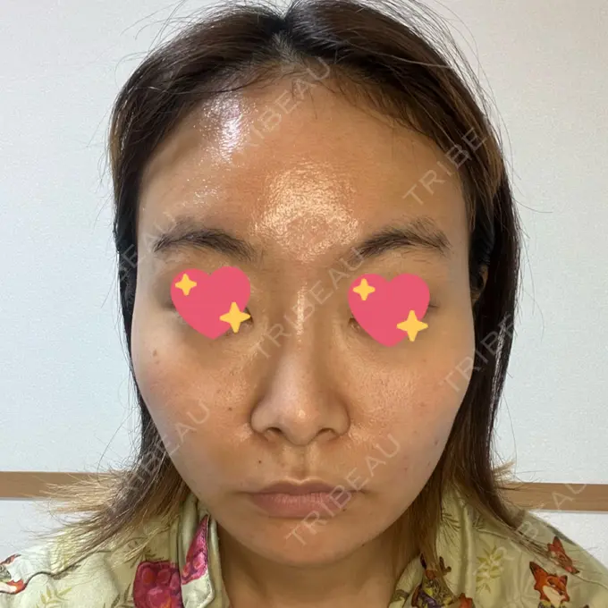 脂肪吸引（顔） ルラ美容クリニック 大宮院 / ルラスキンクリニック 大宮院 DAY 15 メイン用