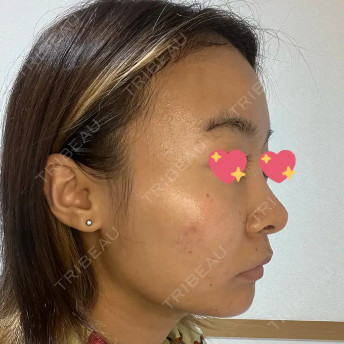 脂肪吸引（顔） ルラ美容クリニック 大宮院 / ルラスキンクリニック 大宮院 DAY 15 メイン用