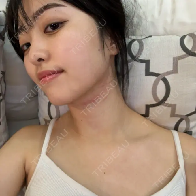 ボトックス（エラ・小顔） ルラ美容クリニック 池袋院 DAY 0 メイン用