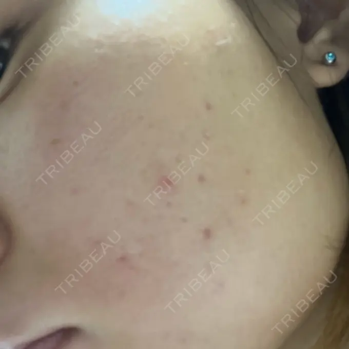 ピコフラクショナルレーザー（毛穴・ニキビ跡） ルラ美容クリニック 大宮院 / ルラスキンクリニック 大宮院 AFTER メイン用