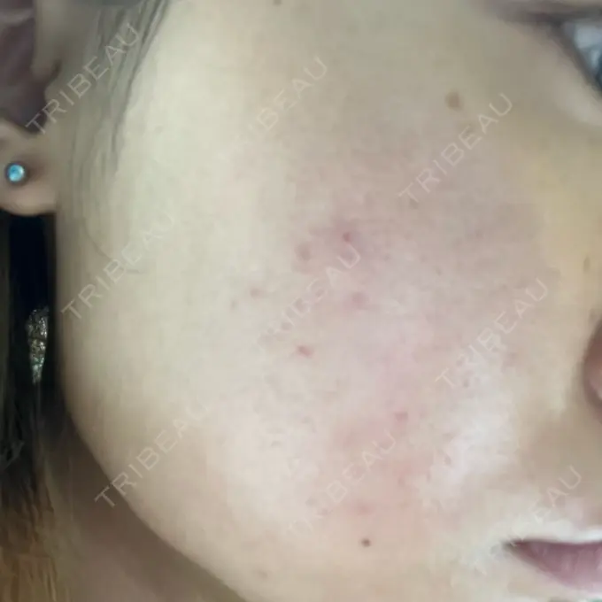 ピコフラクショナルレーザー（毛穴・ニキビ跡） ルラ美容クリニック 大宮院 / ルラスキンクリニック 大宮院 DAY 99 メイン用