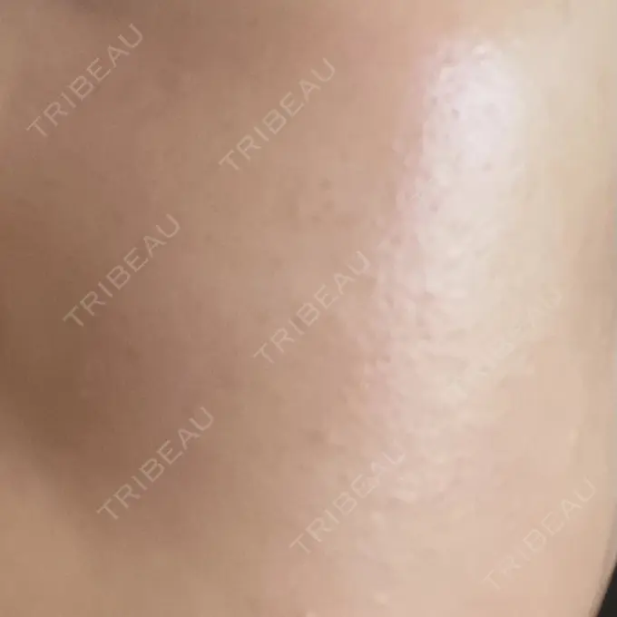 ピーリング（ニキビ・毛穴） 大美会クリニック 岡山院 DAY 9 メイン用