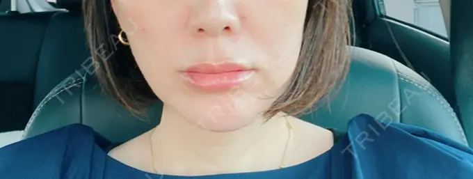 ヒアルロン酸注入（唇） / ヒアルロン酸注入（目の下） アリエル美容クリニック 横浜院 DAY 2 メイン用