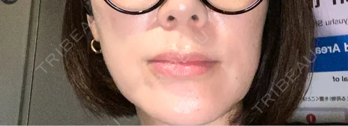 ヒアルロン酸注入（唇） / ヒアルロン酸注入（目の下） アリエル美容クリニック 横浜院 DAY 6 メイン用