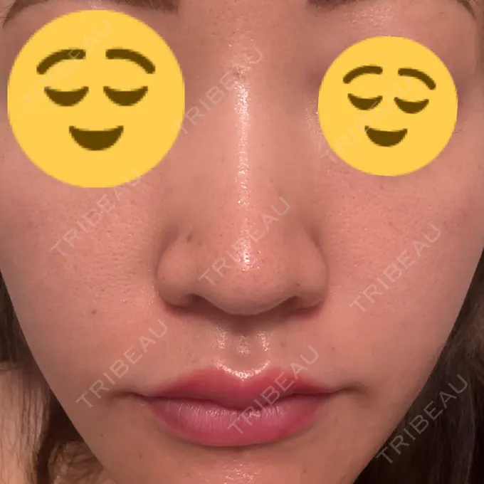 ルメッカ 東京美容外科 池袋院 AFTER メイン用