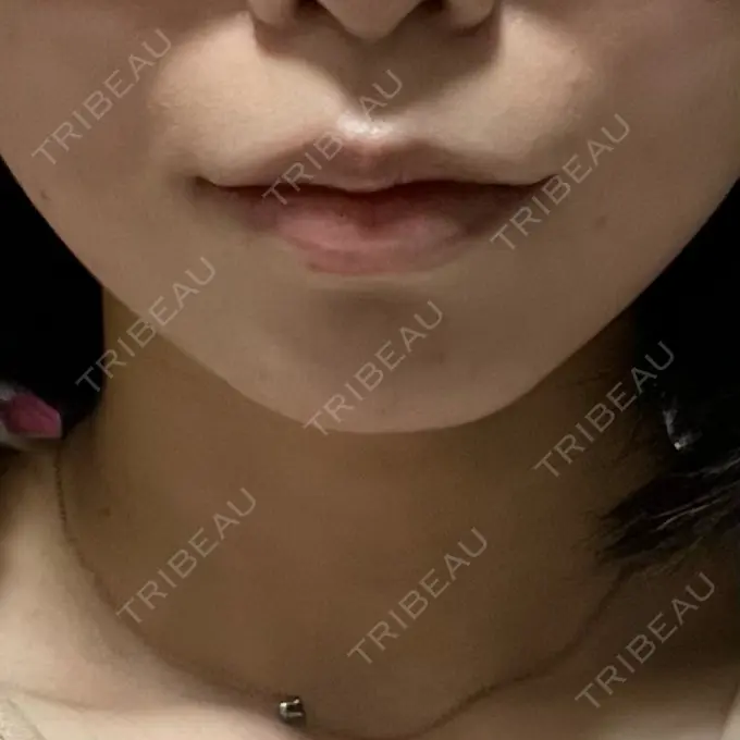 ボトックス（あご） TCB東京中央美容外科 心斎橋院 AFTER メイン用