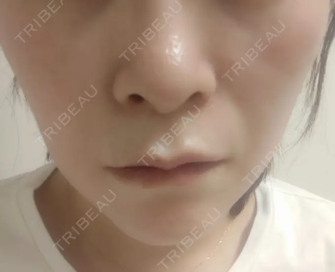 ボトックス（エラ・小顔） 新宿TAクリニック DAY 13 メイン用