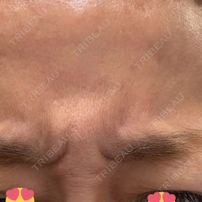 ボトックス（あご） / ボトックス（眉間） / ボトックス（額） / ボトックス（バニーライン） TCB東京中央美容外科 町田院 DAY 0 メイン用