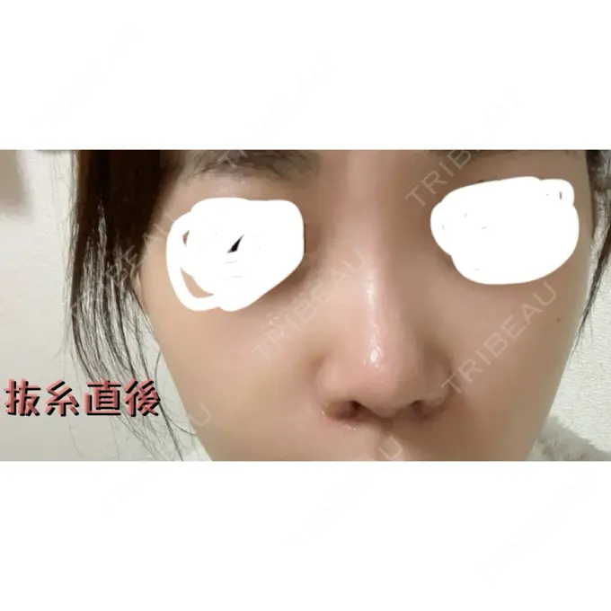 小鼻縮小（切開） / 鼻翼基部形成（貴族手術） / 鼻柱下降・鼻唇角形成（猫手術） eクリニック 福岡院 DAY 0 メイン用