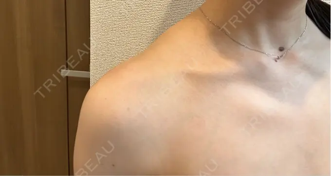 ボトックス（肩） ルラ美容クリニック 静岡院 DAY 8 メイン用