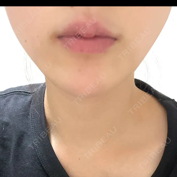 糸リフト アリエル美容クリニック 横浜院 AFTER メイン用