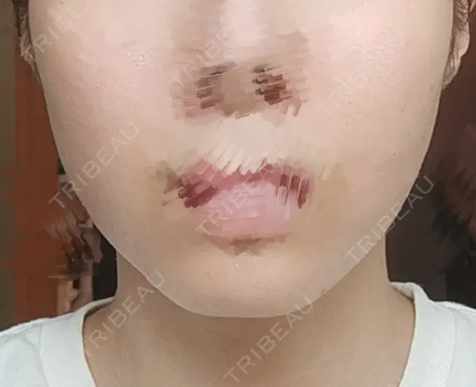 その他（輪郭） BITO BEAUTY CLINIC DAY 0 メイン用