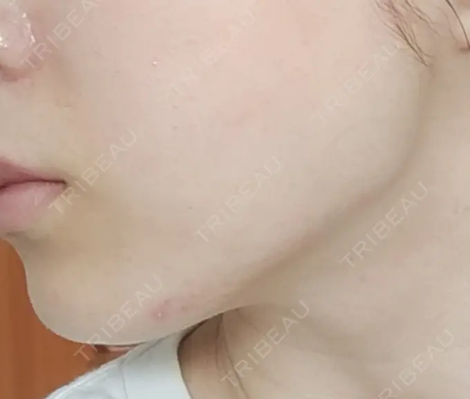 その他（輪郭） BITO BEAUTY CLINIC DAY 0 メイン用