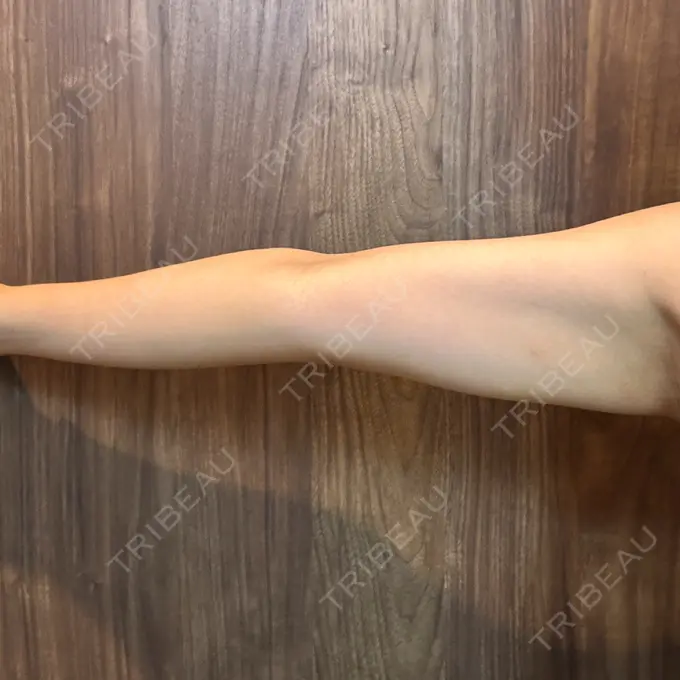 脂肪溶解注射（二の腕） 東京秘密クリニック 渋谷院 AFTER メイン用