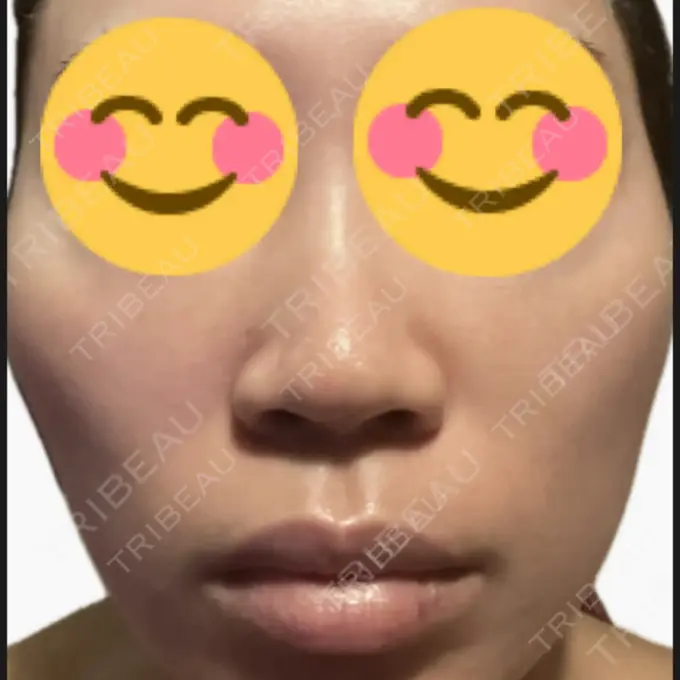 プラセンタ注射 / その他（肌） 美容皮膚科エルムクリニック 麻布院 AFTER メイン用